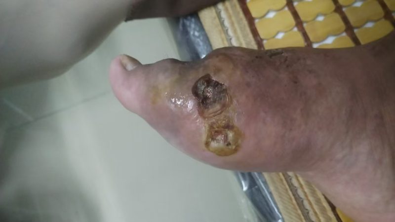 图片[5]-客户因为痛风做手术后伤口一个月都不愈合，反复流脓。用醋蛋液一早上竟然结痂啦-醋蛋归元液用户养生分享集圈子社区-智健家