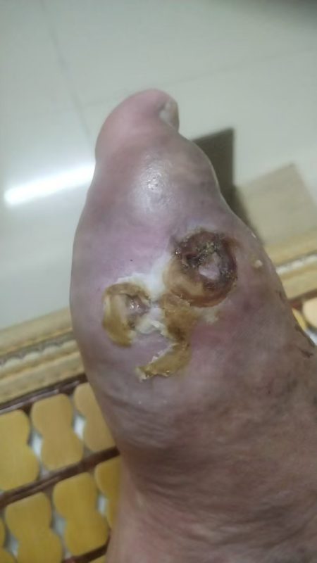 图片[6]-客户因为痛风做手术后伤口一个月都不愈合，反复流脓。用醋蛋液一早上竟然结痂啦-醋蛋归元液用户养生分享集圈子社区-智健家