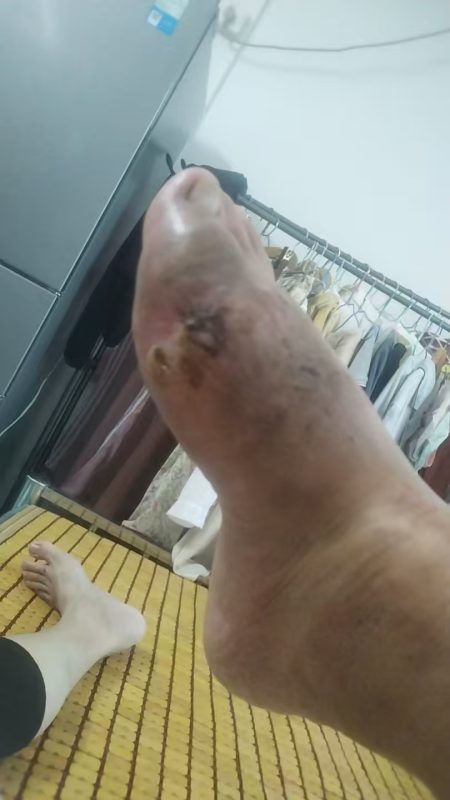 图片[7]-客户因为痛风做手术后伤口一个月都不愈合，反复流脓。用醋蛋液一早上竟然结痂啦-醋蛋归元液用户养生分享集圈子社区-智健家